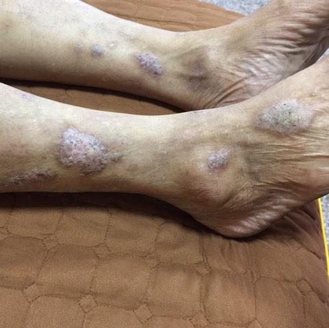郑荣杰皮肤问题修复神经性皮炎
